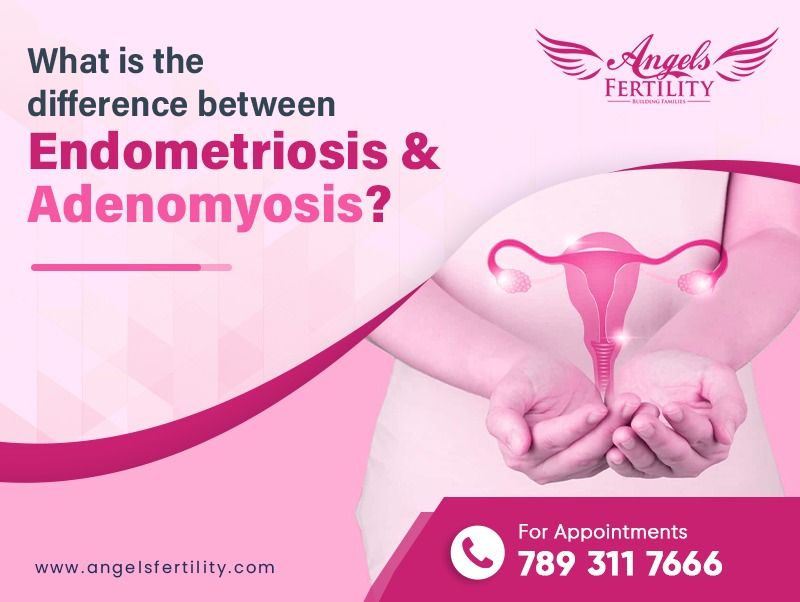 What is the Difference Between Endometriosis and Adenomyosis?