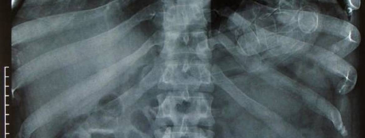 x ray of human chest