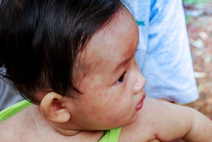 Measles