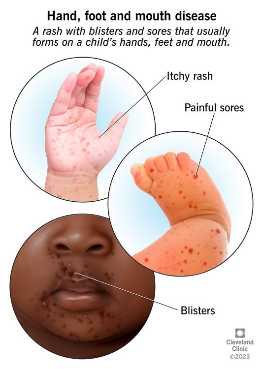 Hand Foot Mouth Disease-2.jpg