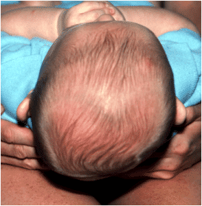 plagiocephaly-294x300.png