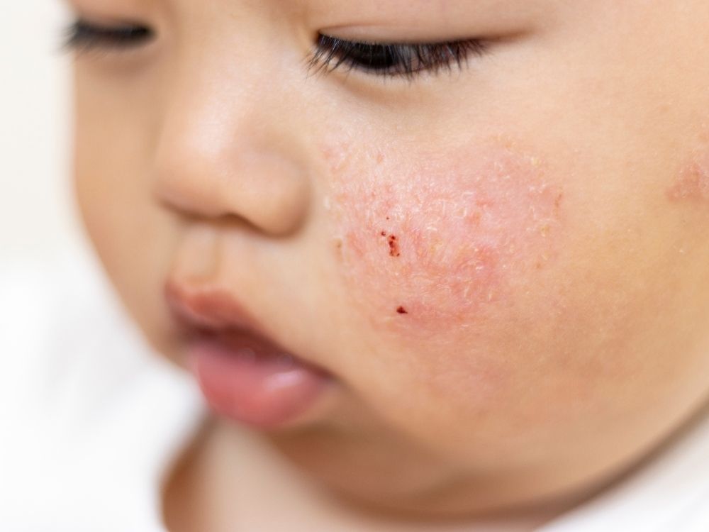 eczema.jpg