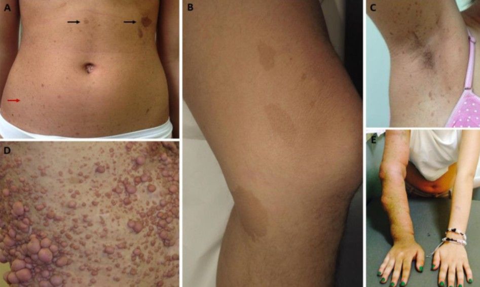 neurofibromatosis.jpg