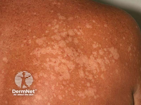 tinea versicolor.png