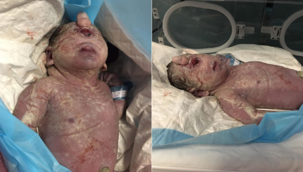cyclopia.png