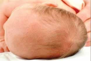 Dolichocephaly_head_800x.jpg