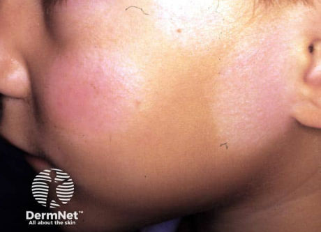 tinea alba.png