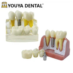 4 volte impianto denti modello protesi ponte corona porcellana modello di restauro per dentista