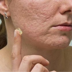 TCM Acne Scar Cream Natural Herbal Treatment For Clear, Smooth Skin TCM Acne Scar Cream Natural Herbal Treatment For Clear, Smooth Skin