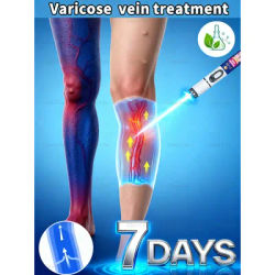 2nd generation painless treatment for spider veins and blood congestion in the legs