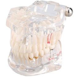 Anatomisk tannmodell - Tannprotese - Hvit