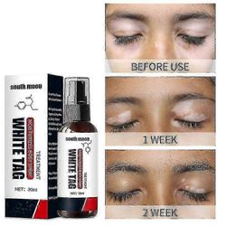 Vitiligo-suihke, vitiligon hoito iholle Vitiligo, vitiligon hoitosuihke valkoisten läiskien vähentämiseen