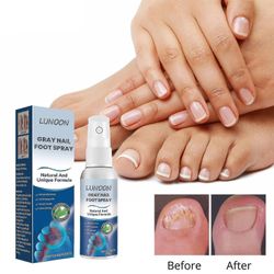 1-3kpl/Antifungals kynsihoitosuihke Medicals laatua, 30 ml, Antifungals kynsihoidot, Antifungals spray 30ml 1pcs
