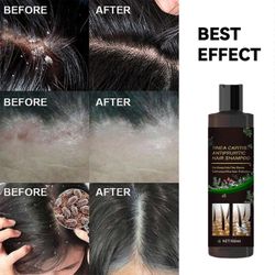 Kutinaa estävä shampoo Tinea Capitisille hilseeseen ja lievittää kutiavaa päänahkaa Monivärinen