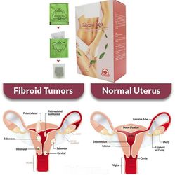 Herbal Female Fibroid naturlig te livmor fibroid anti betennelse