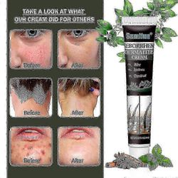 Psoriaattisen seborrooisen dermatiitin hoito kerma pää akne kutina päänahka silsa korjata iho puhdistusvoide hiukset päänahan hoito 3pcs