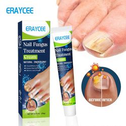 unbrand Sienikynsivoide, kynsien korjausvoide, vahva sieniä estävä varpaankynsivoide, kynsien korjaus ravitseva hoito, palauttaa värjäytyneet ja va...