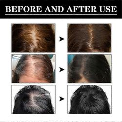 3kpl nopeasti kasvava hiustenlähtöä estraalinen öljy Eelhoe Rosmariini Hair Growth Oil Repair -8207620377983