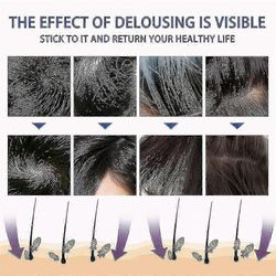 Päätäiden poisto Spray Karvat Poistaa täitä ja kirppuja Poistaa täiden munat ja P