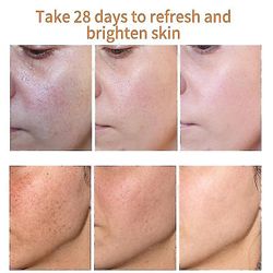 Ny 2023 krem Fjern Melasma Melanin S At L hudpleie Changzhao 1pcs