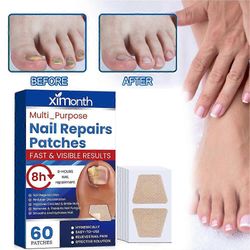 60kpl(A)$Ximonth Kynsien korjauslaastarit käsille ja jaloille Pehmeät kynnet Sisäänkasvaneet kynnet paksuuntuvat kirkkaat kynnet Kynsiuran Onykomyk...