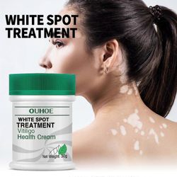 Vitiligo-hoitovoide, joka poistaa pigmentaation raunioyrtti antibakteerinen vähentää ihon valkoisia täpliä