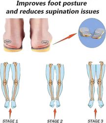 Supinaatiopohjalliset ylisupinaatioon ja korkeaan kaaritukeen, ortoosit jalkojen linjaukseen, kolhiintuvaan polvikipuun, keulajalkoihin, O/x Tw 39–40