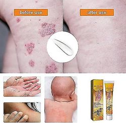 Bee Venom Psoriasis Treatment Cream, Nya Zeeland Bee Venom Professional Psoriasis Treatment Cream, psoriasis Treatment Cream 1pc