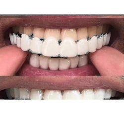 Uusi Snap On Smile Dental False Teeth Cover Smile Iluers Comfort Fit Flex Proteesin hampaat - Niubi_l25 Ylemmät hampaat