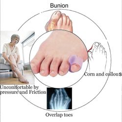 10 pakkausta Pieni varvaslasta, geelivarpaiden erotin, pieni varvassuoristimen vasaravarvas