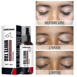 Vitiligo-suihke, vitiligon hoito iholle Vitiligo, vitiligon hoitosuihke valkoisten läiskien vähentämiseen