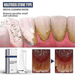 Hammaskivi- Liukeneva hammaskiven poisto Hampaiden täydellinen poisto Tootaste