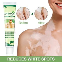 20g Piebald Care Health Care Cream White Spot Net Salve Piebald Sweat Spot Vitiligo Skin Aktuelt 1pcs