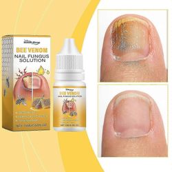 Bee Venom Nail Treatment Serum Sisäänkasvanut varpaankynsihoito Kynsien hoitoöljy, varpaankynsien vastainen sienihoito Varpaankynsien sieniliuos
