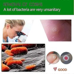 Maissinpoistoaineet jalkojen varpaille, maissinpoistoaineet salisyylihapolla, maissinpoistokantapää kalluksenpoistomaissityynyt