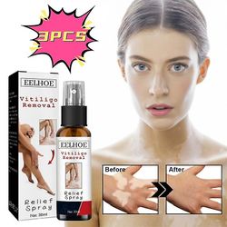 Lequeen 3 stk urteekstrakt vitiligo spray Fjern ringorm fjerning av hvite flekker hud hvit flekkbehandling spray