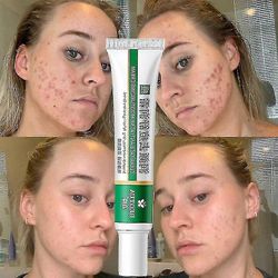 Effektiv Acne Removal Cream Aloe Acne Spots Oil Control Anti-aging Moisturizing Whitening Acne Cream Treatment Hudvård 20g 1PC