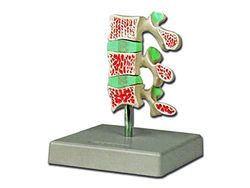Modelo anatómico Osteoporosis avanzada, para estudiantes, Universidad, didáctica