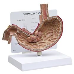 GPI Anatomicals Model raka żołądka