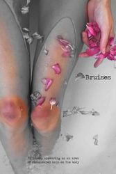 Bruises: 6