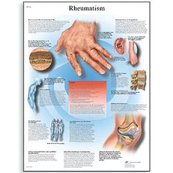 3B Scientific Vetenskaplig mänsklig anatomi - reumatiska sjukdomar diagram, pappersversion