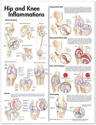 Hip and Knee Inflammations Anatomical Chart