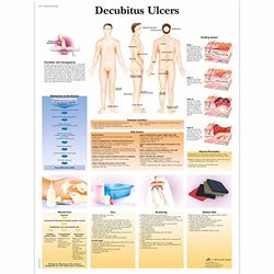 3B Scientific Vetenskaplig decubitus Ulcers diagram, unlaminated