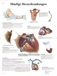 3B Scientific VR0343UU - Póster explicativo sobre enfermedades comunes del corazón (en alemán)