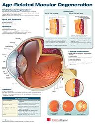 Age-related Macular Degeneration