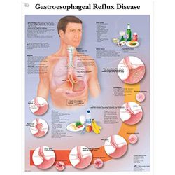 3B Scientific Anatomie humaine - Tableau des maladies du reflux gastro-œsophagien, version plastifiée