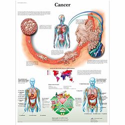 3B Scientific Anatomia człowieka - wykres raka, wersja papieru