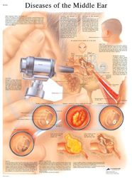 3B Scientific Anatomia człowieka - choroby wykresu ucha środkowego, wersja laminowana
