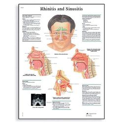 3B Scientific Vetenskaplig rinit och bihåleinflammation, unlaminated