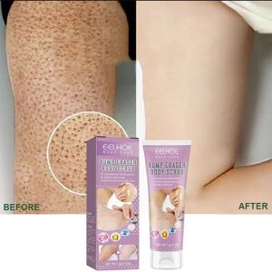 Keratosis Pilaris Cream For Strawberry Legs Removal KP Bump Eraser Dark Spots Face Body Smooth Whitening Moisturizes Skin Care